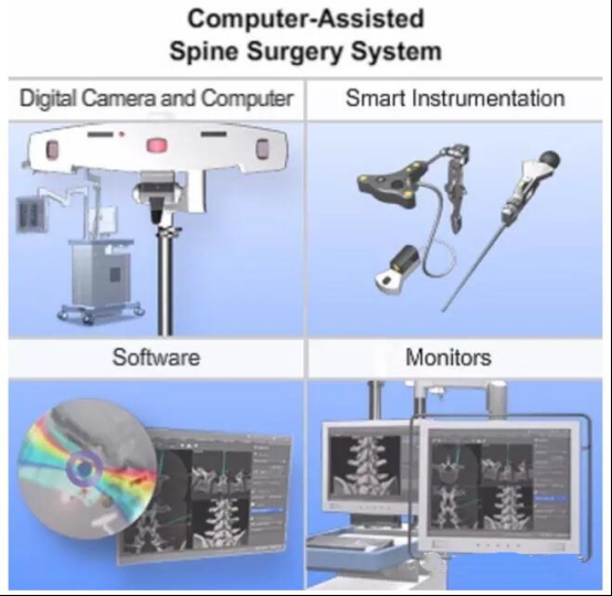 計(jì)算機(jī)輔助脊柱外科手術(shù)(Computer-assisted spine surgery)